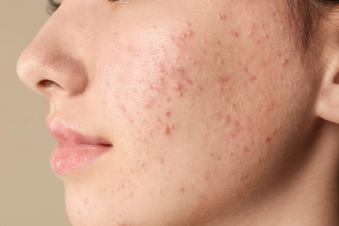 What is Acne and Solution for it
